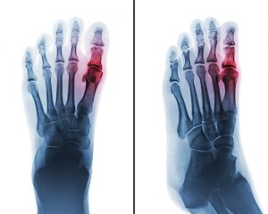 What Men Need to Know About Gout